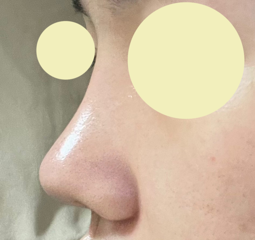 첫눈,첫코성형  4개월차입니다!