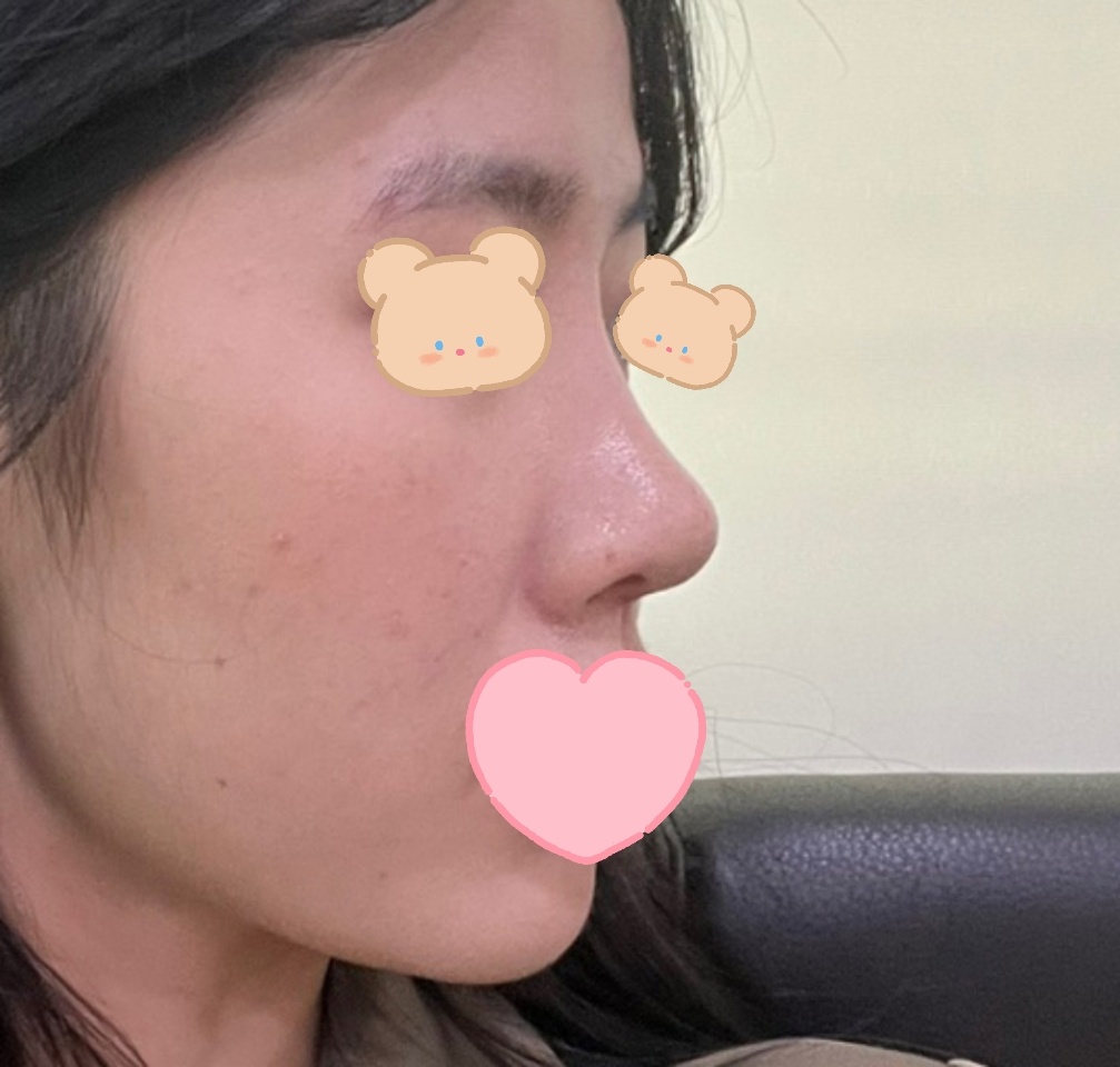 코 2개월 되구 후기적어용