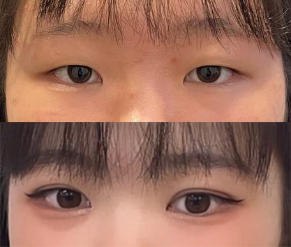 졸린눈이었는데 눈성형하고 또렷해졌슴당