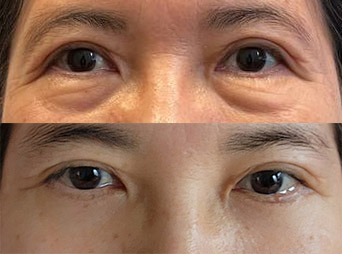 하안검 만족스럽네요^^