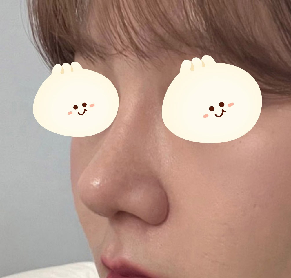 코수술1달차! 자연스럽게 잘됐어요