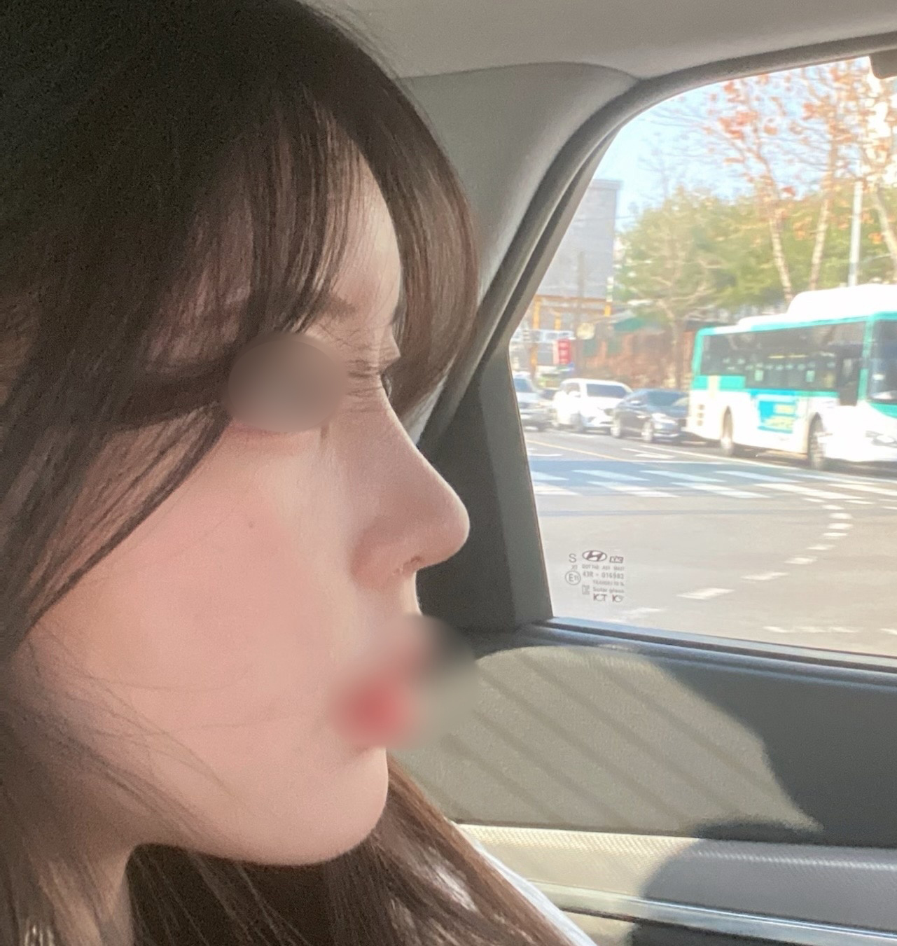 코+지방이식 강력추천드립니드앙