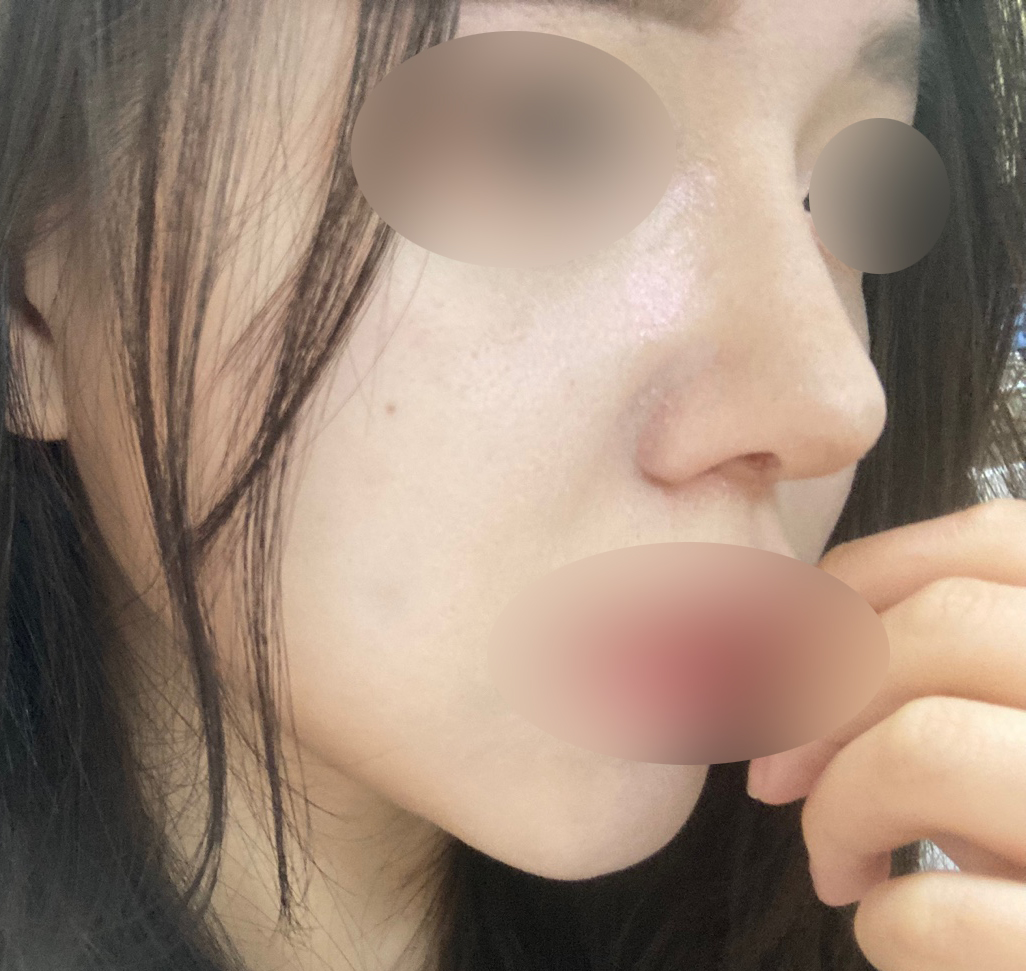 복코성형+심부볼지방제거 했습니닷