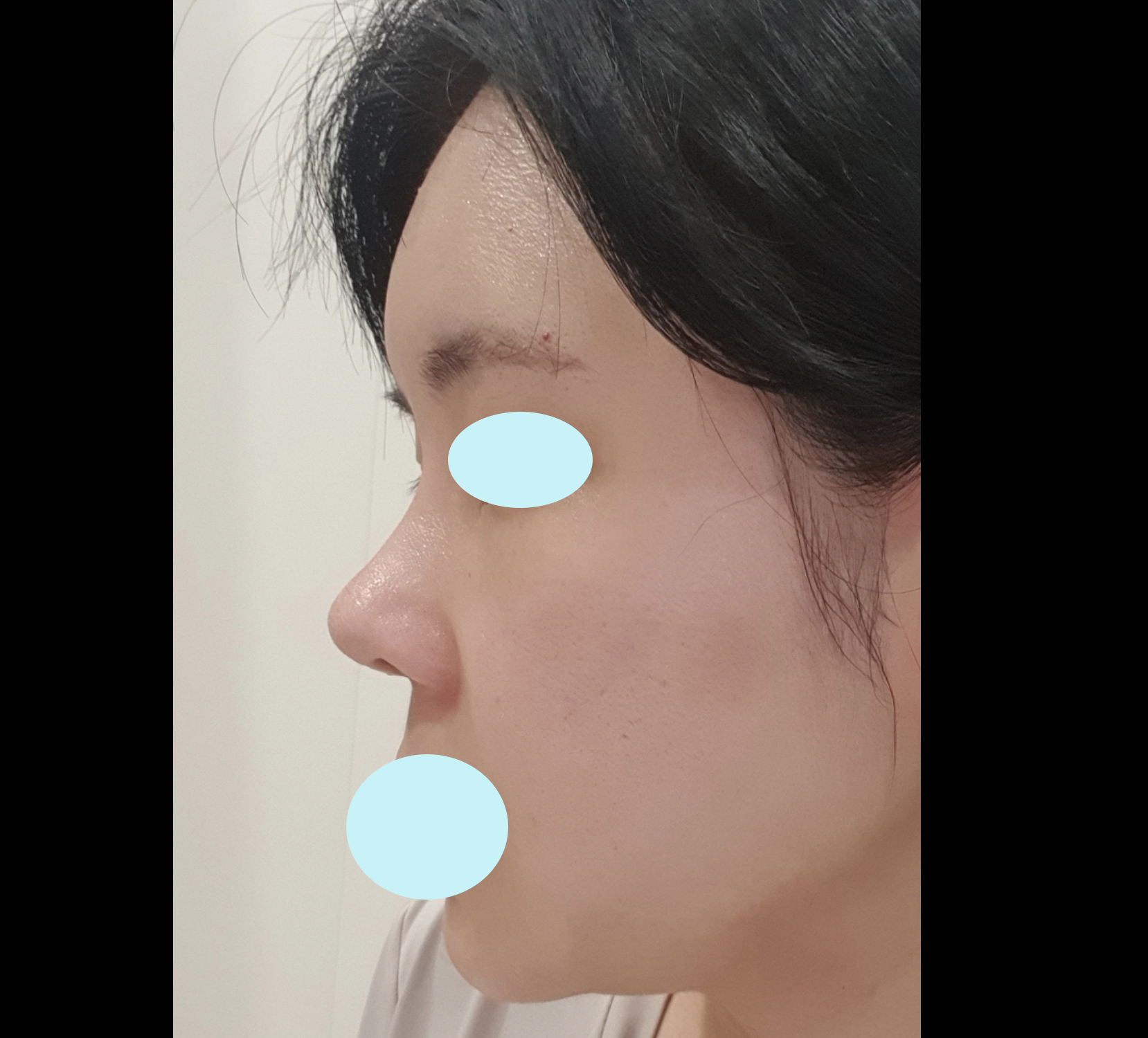 코수술+풀페이스지방이식 2개월차 후기올려욥><