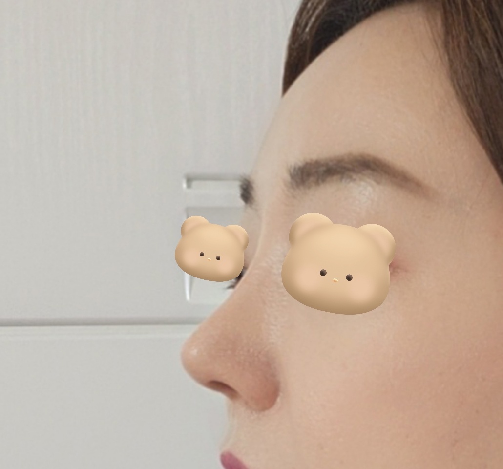 바이브에서 코마지막수술했어요~