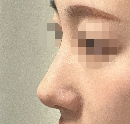 무보형물 매부리코수술! 다들 이쁘다네요><