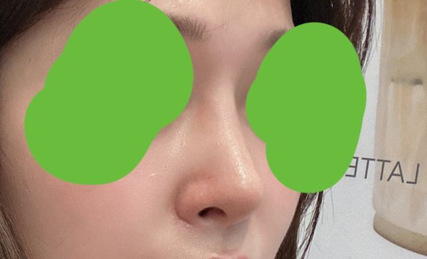 7군데 돌고 바이브로 결정! 코수술후기ㅎㅎ