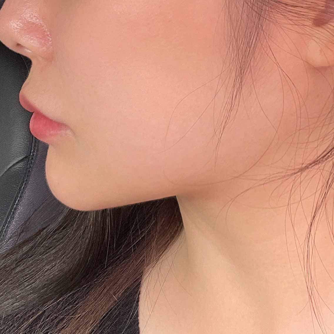 이중턱 고민이라면 추천~