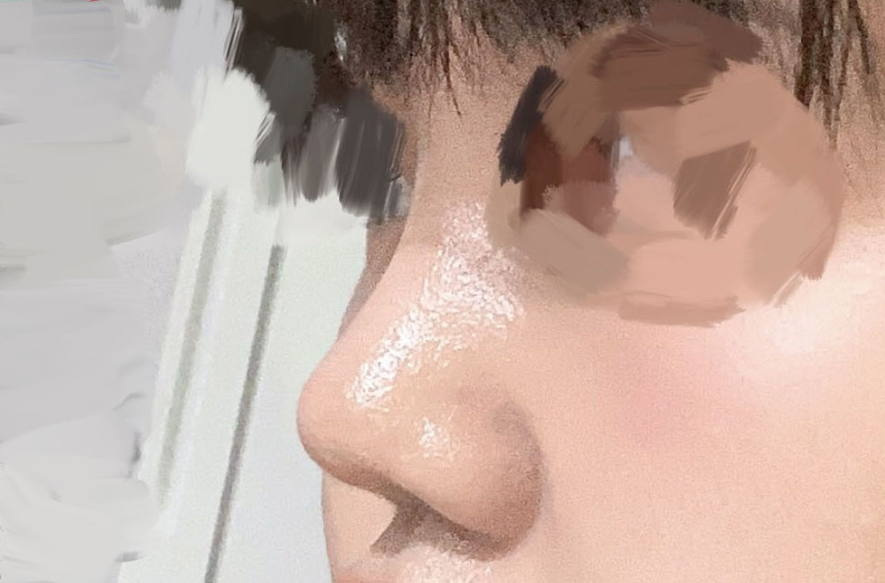 복코수술잘하기로 유명하다는 바이브에서 수술!!4갤차