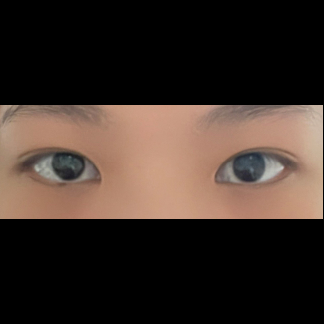 눈매교정 6개월차! 넘 자연스러워요!