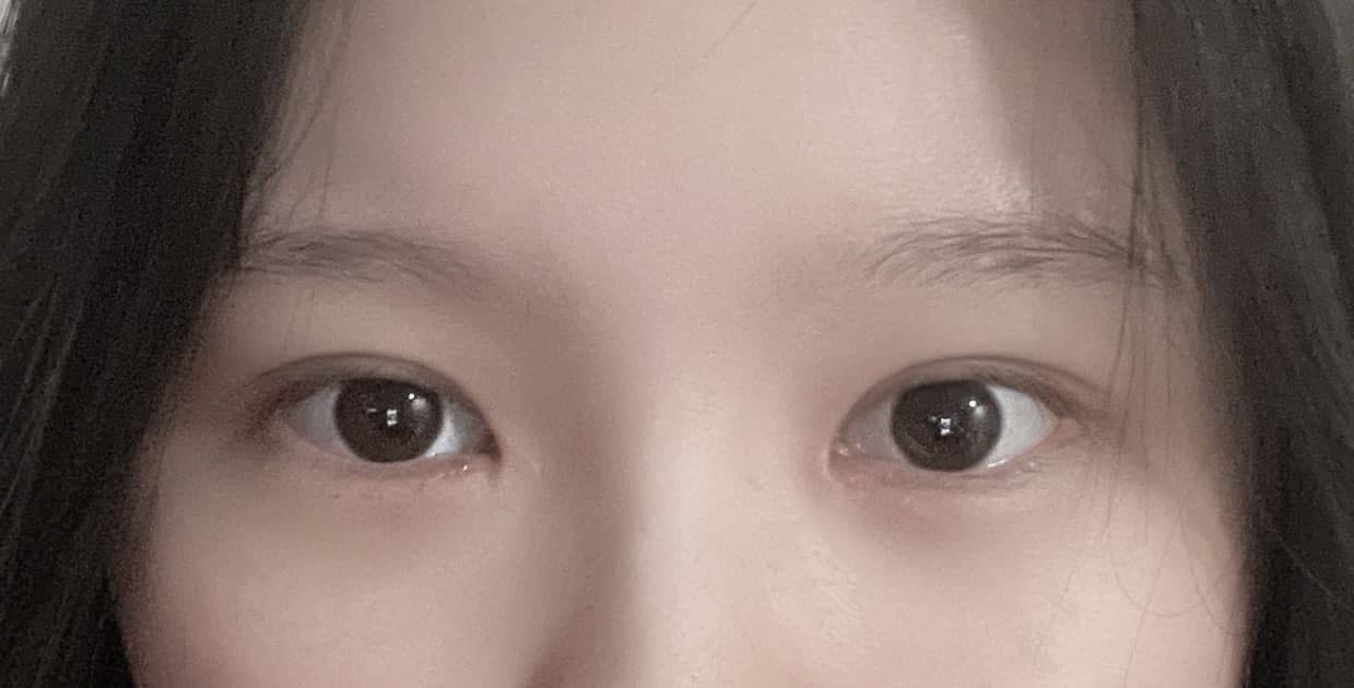 쌍꺼풀에 대한 스트레스가 없어지니까 너무 좋아요