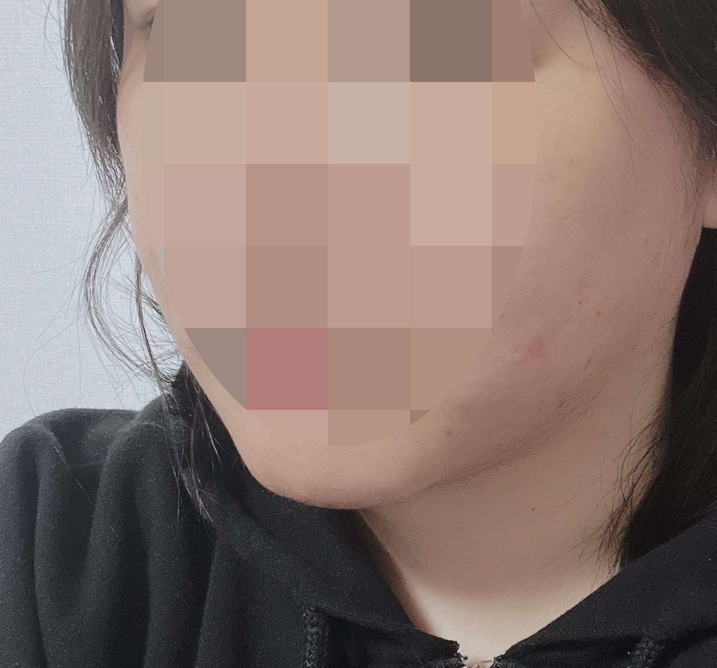 지방흡입 효과 매우 좋아요~!