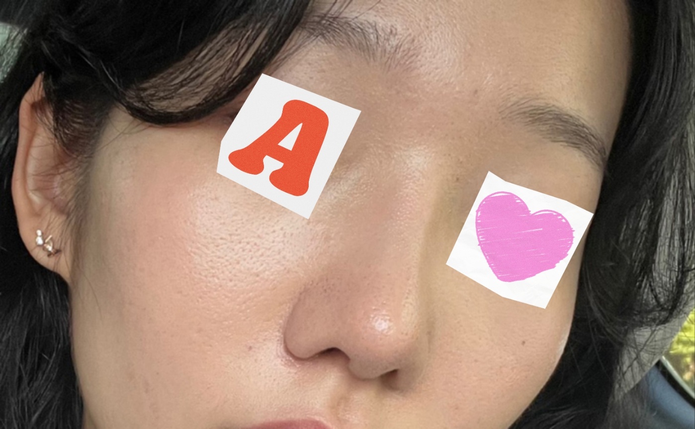 코수술 1달차ㅎㅎ굿굿