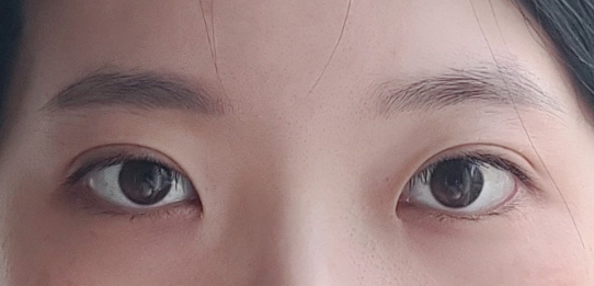 비절개눈매교정 후기!