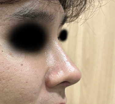 눈코한지 벌써 4개월차! 후기씁니다~