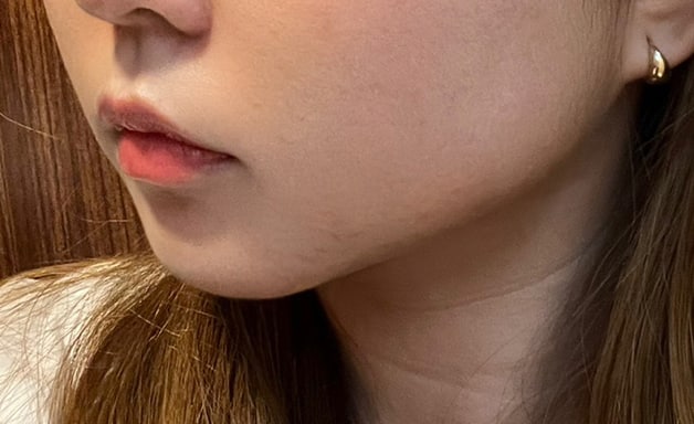 이중턱+심부볼제거 후기