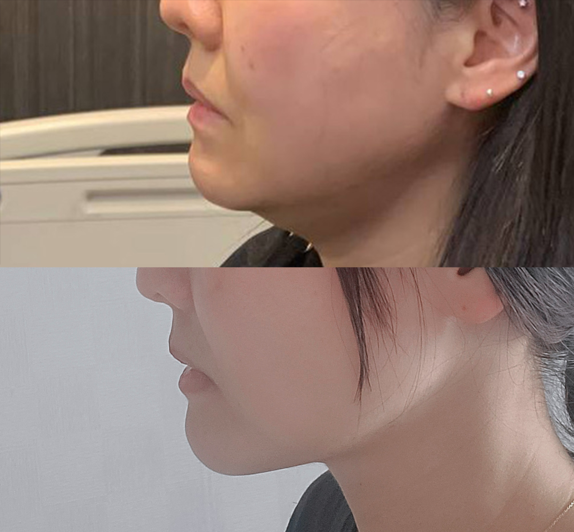 지방흡입 3개월지났어요 ㅎㅎ 투턱이별!