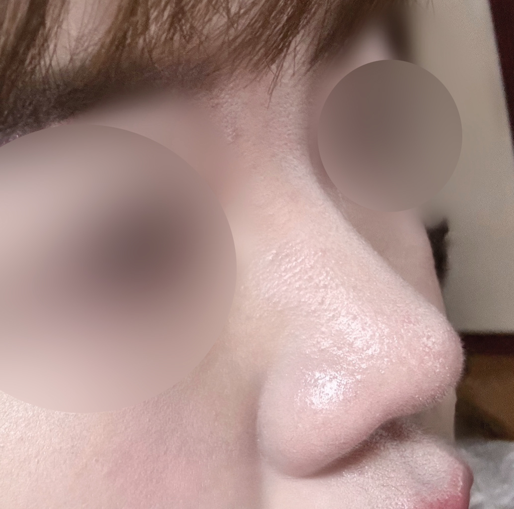 벌써 코수술받은지 반년넘어가요~!!