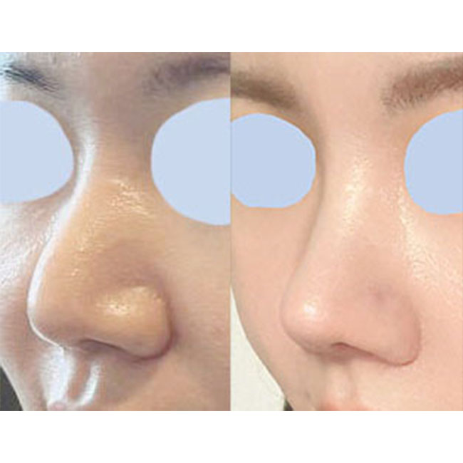 코재수술 2개월차 대만족스럽습니다:)