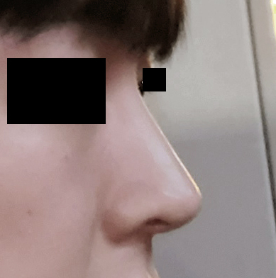 남자코성형 바이브 유원장님 추천합니다!!