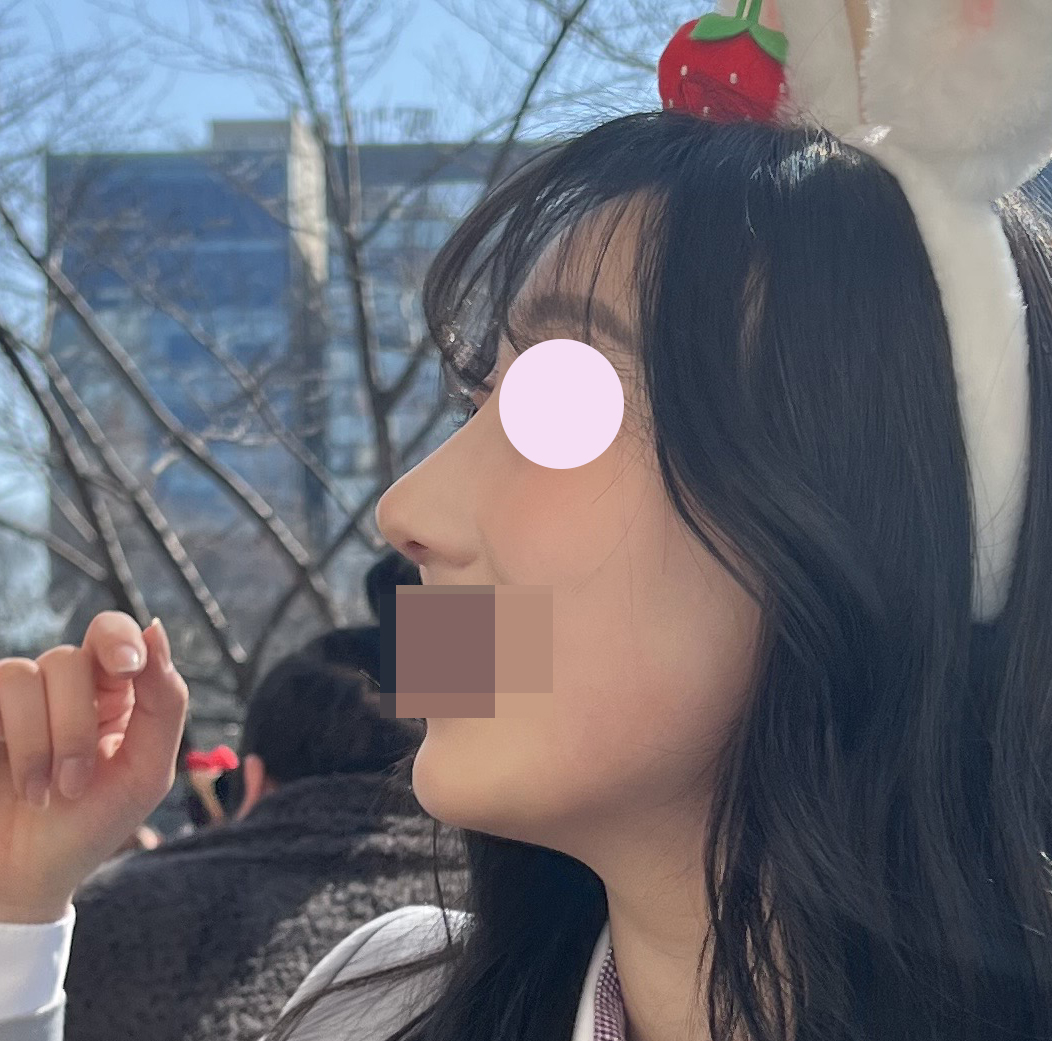 눈+코 수술 2개월차입니당