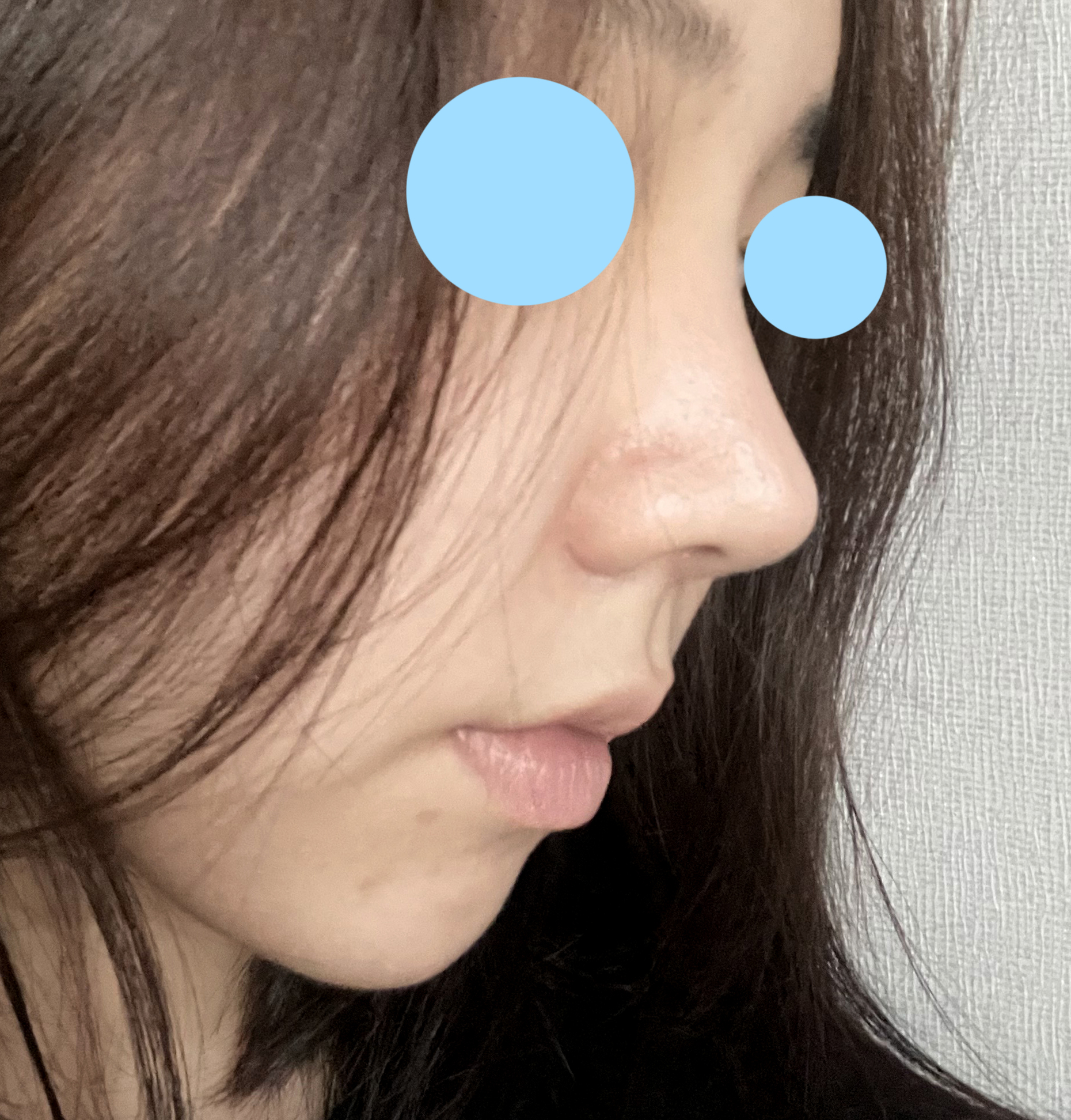 코, 얼굴지방흡입 둘다 만족만족굿