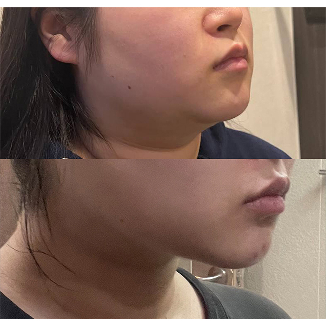 얼굴지방흡입 4개월차~~