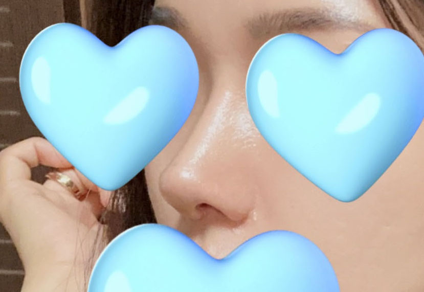 상담도 꼼꼼! 코재수술 결과도 만족쓰!