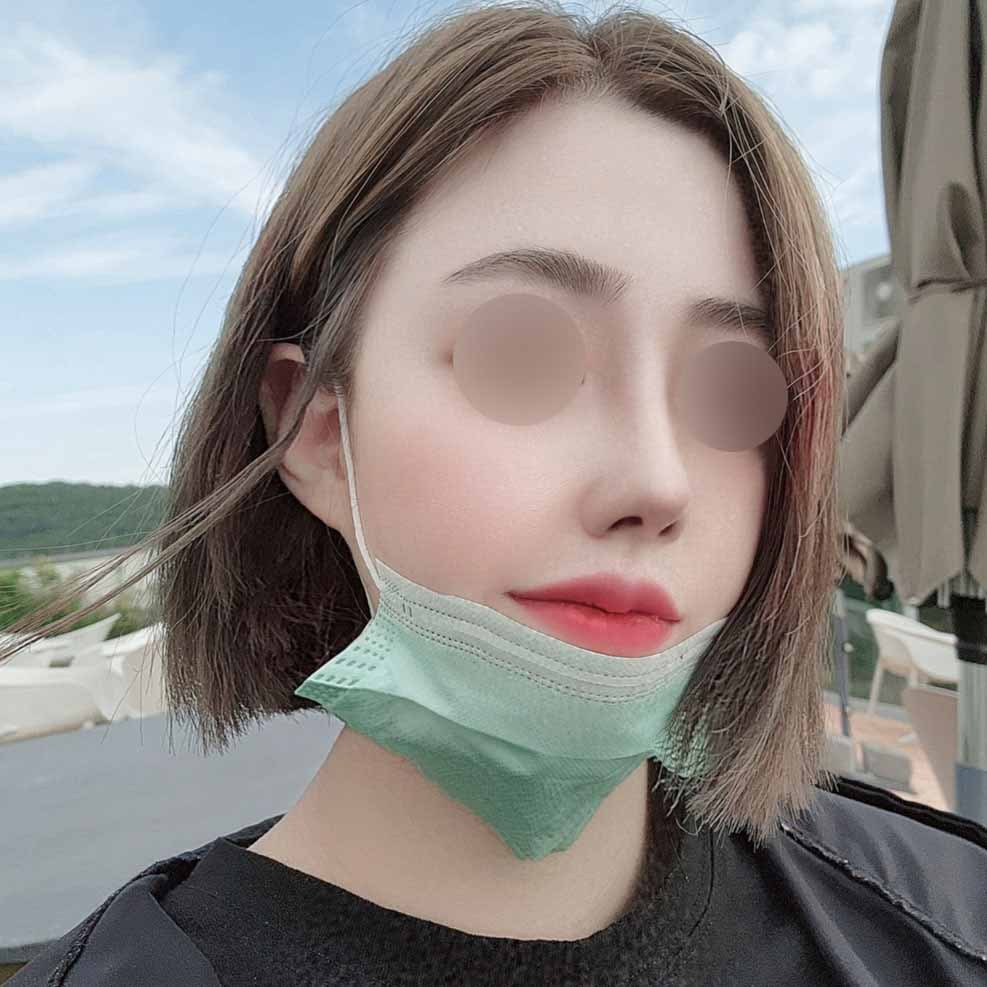 눈 코 내시경이마거상 얼굴지흡 한번에 했어요~