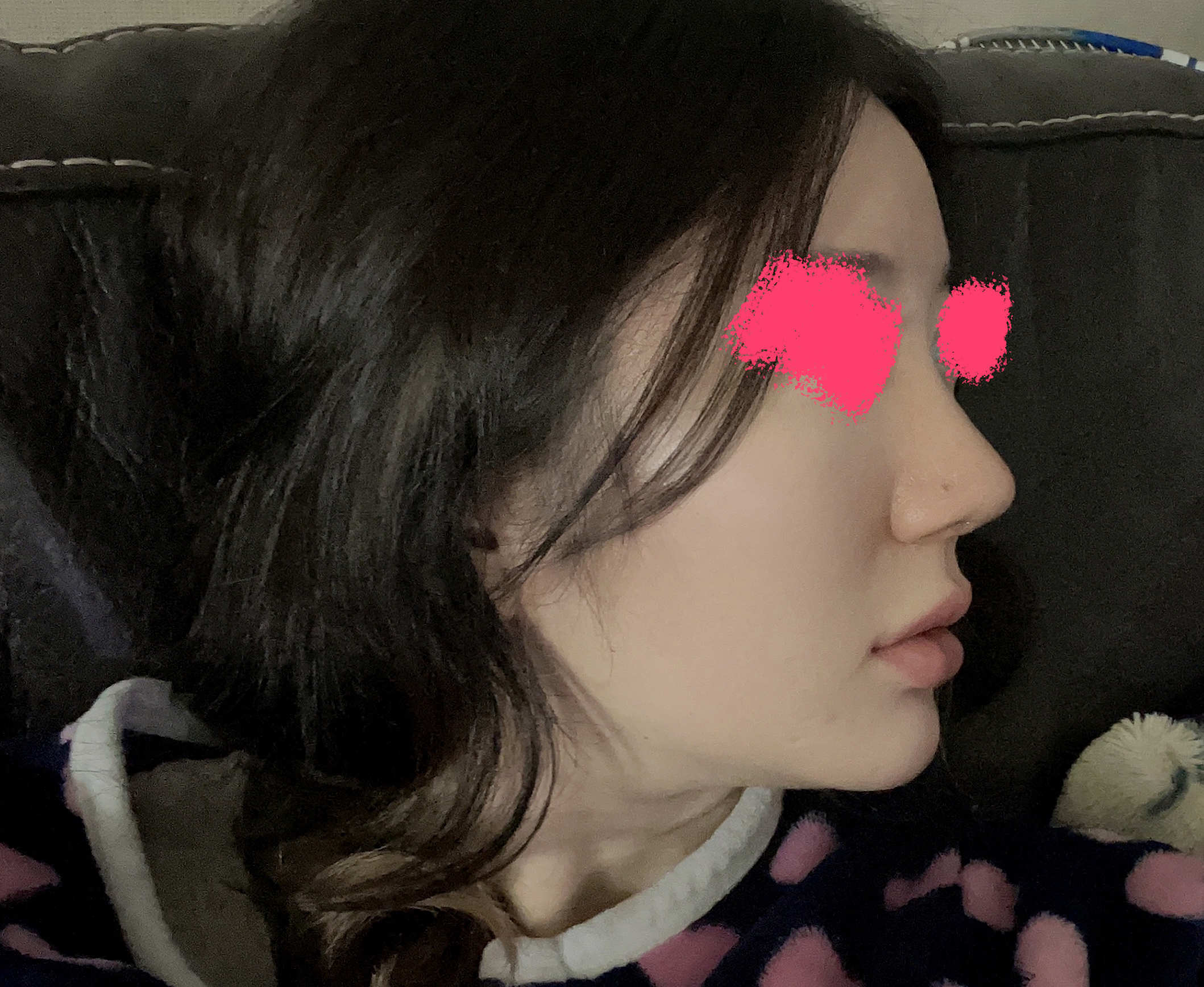 코끝재수술+얼굴지방흡입+심부볼제거