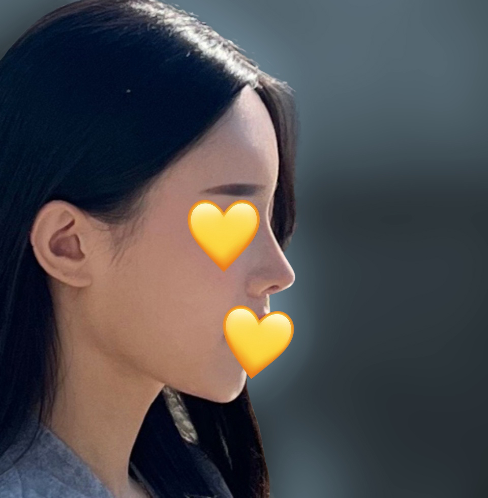 코&지방이식 3주차^.^