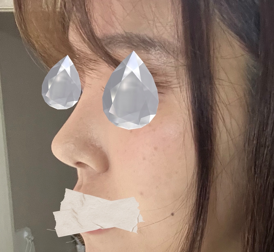 자연스럽고 예쁜 코로 만들어주셨습니다 ㅎㅎ