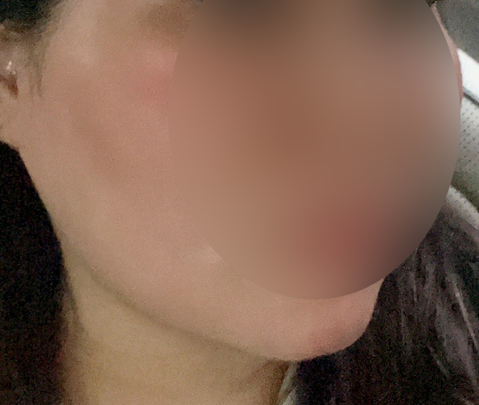 이중턱지흡 후기남겨요~~~~