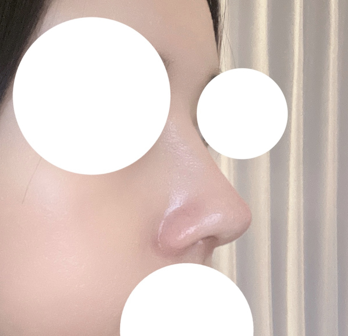 코수술 만족도 최상!!