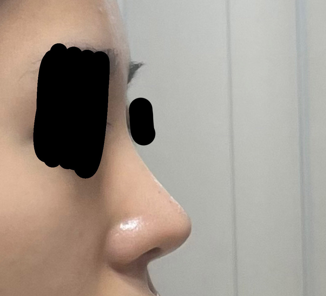 기능코수술 세달차 후기써요