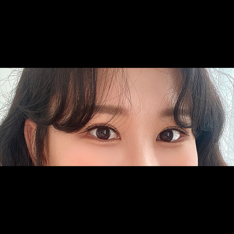 절개 쌍수 재수술 6개월