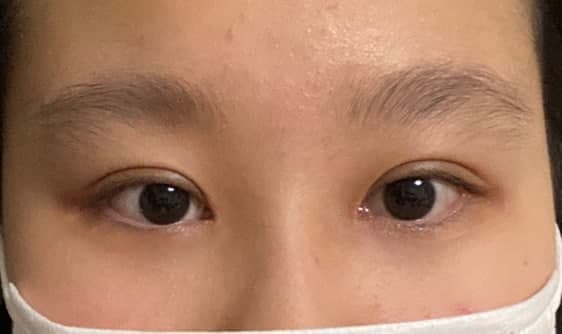 #비절개눈매교정 #앞트임