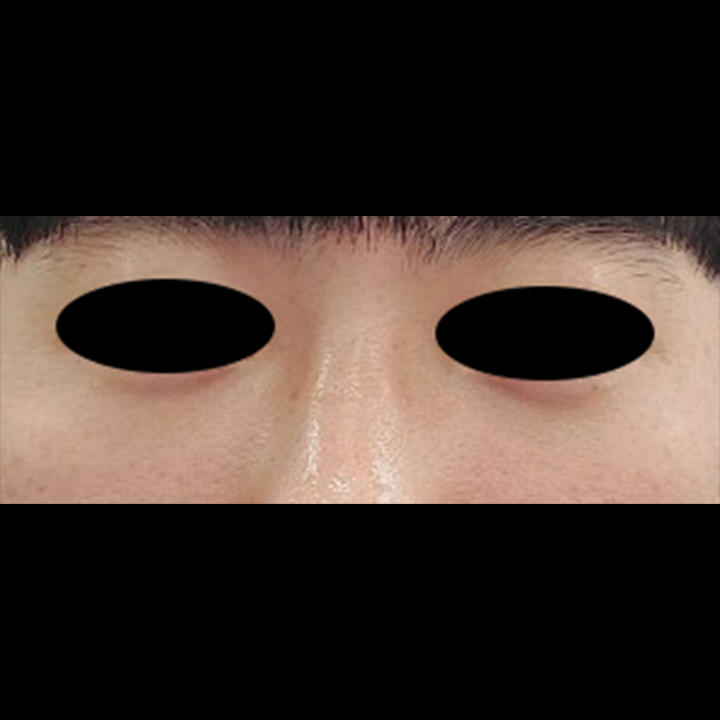 남자 눈밑지방재배치 후기입니다.