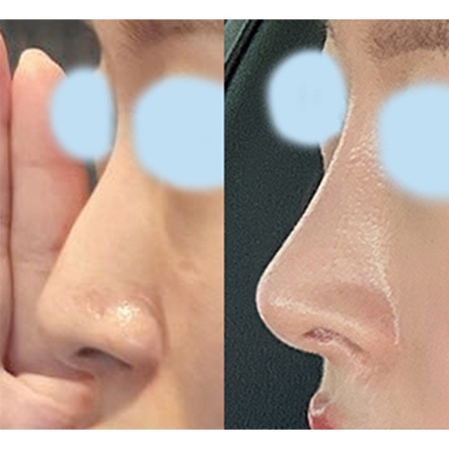 매부리코성형한지 5개월차됐습니당