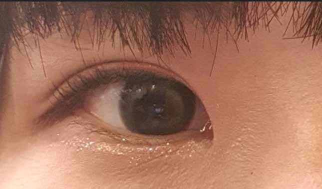 유영문 원장님 쌍수 완전 추천합니다