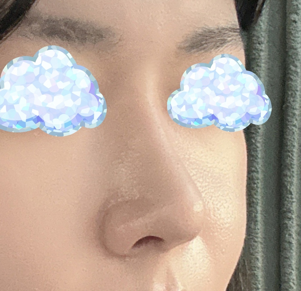 매부리코였던 제코ㅠㅠ교정 제대로 됌!