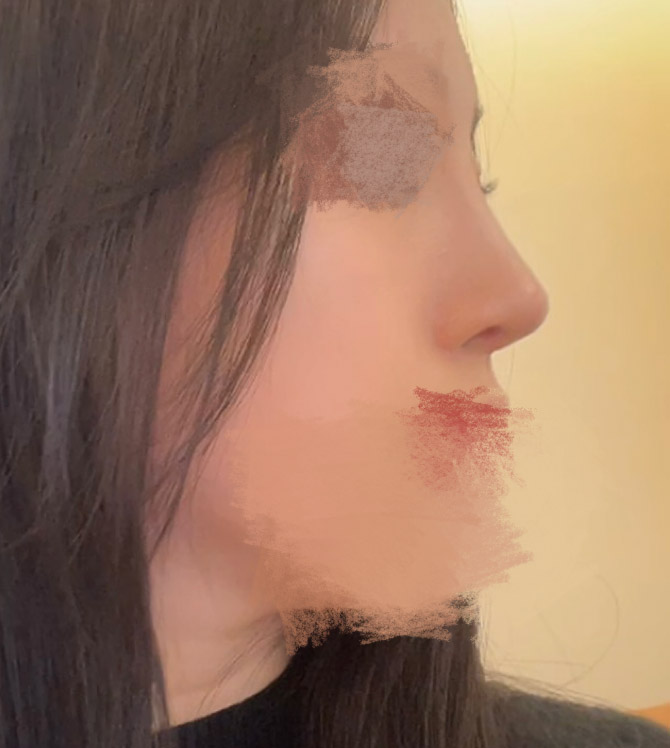 코재수술 만족200%