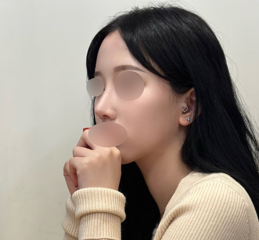 매부리코성형 4달차 만족^-^