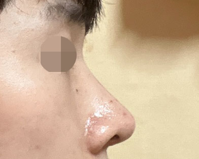 무보형물 코성형2달차 후기