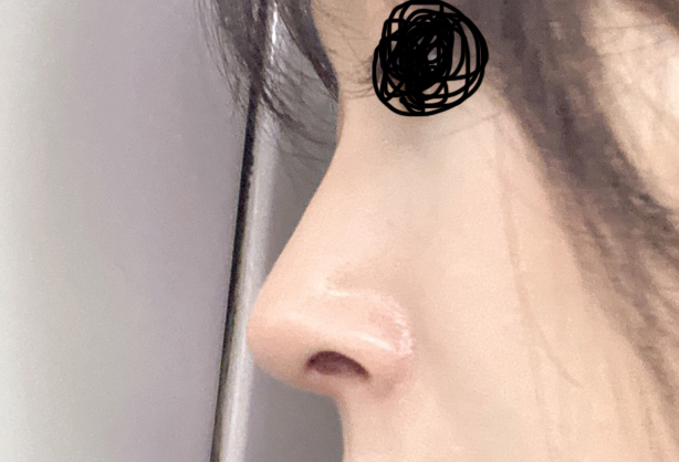 무보형물코성형 바이브에서 했는데 너무나 잘됌요