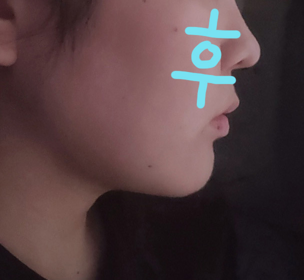 리포사운드지방흡입으로 이중턱 뿌신 후기!