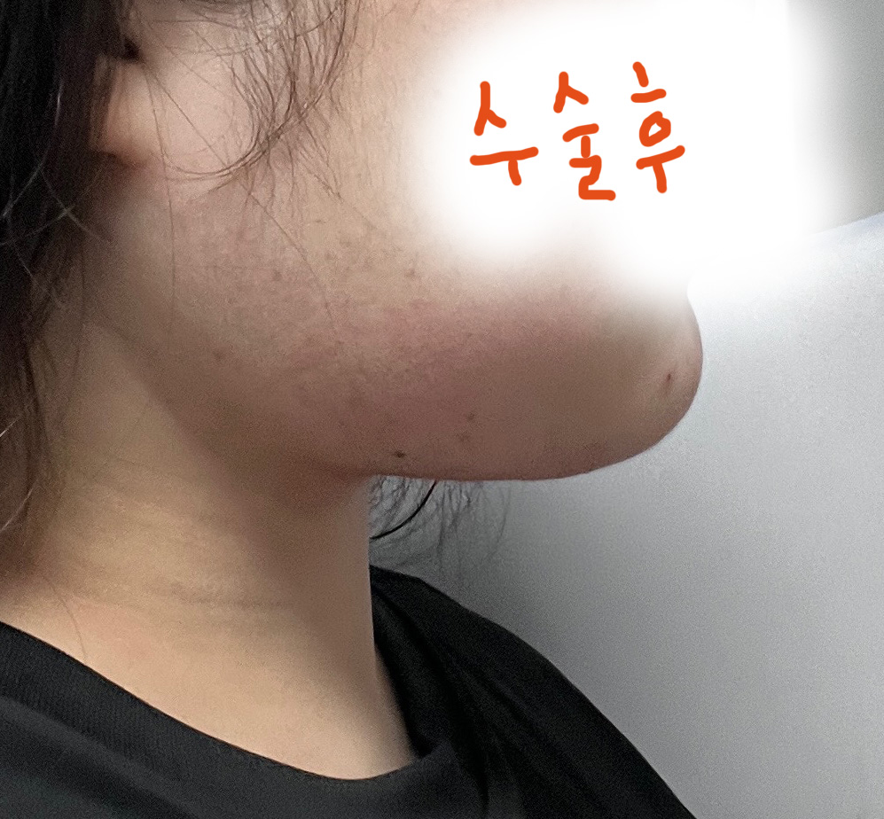 지방흡입 안했음 후회할뻔ㅎㅎ