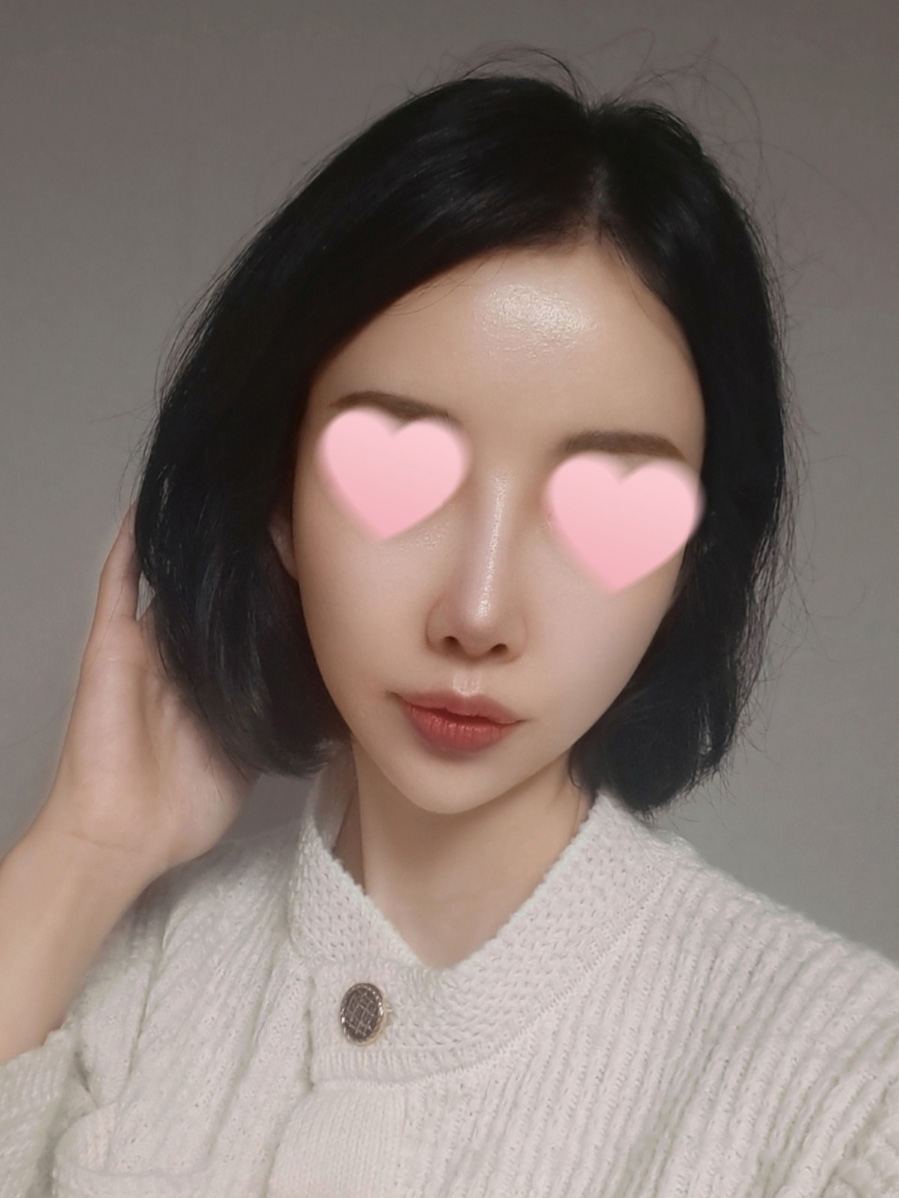코성형+풀페이스지방이식