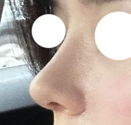 유원장님께 코수술받은지 4주차