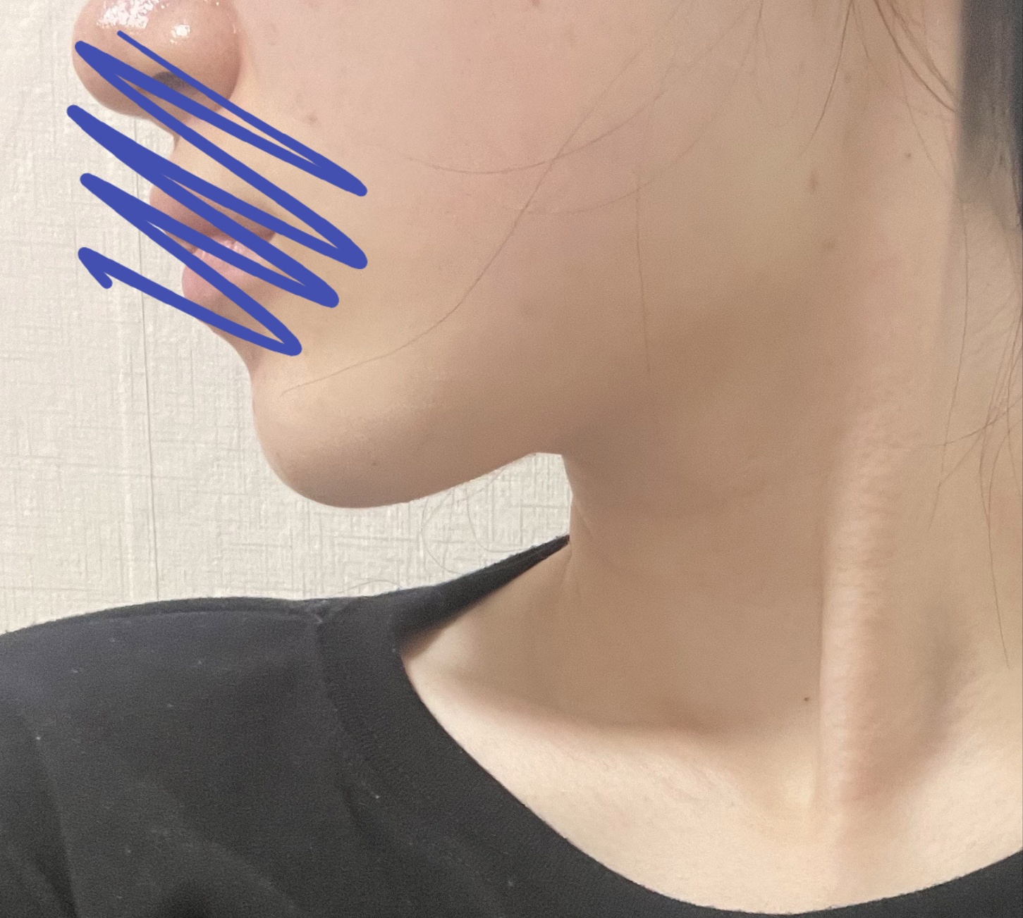 다른 시술 효과못보고 얼지흡하고 효과봤어요:)